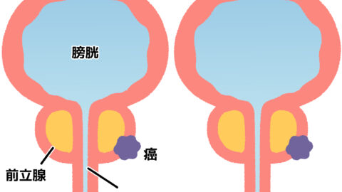 排尿トラブルだけじゃない！前立腺がんの症状と予防法について解説