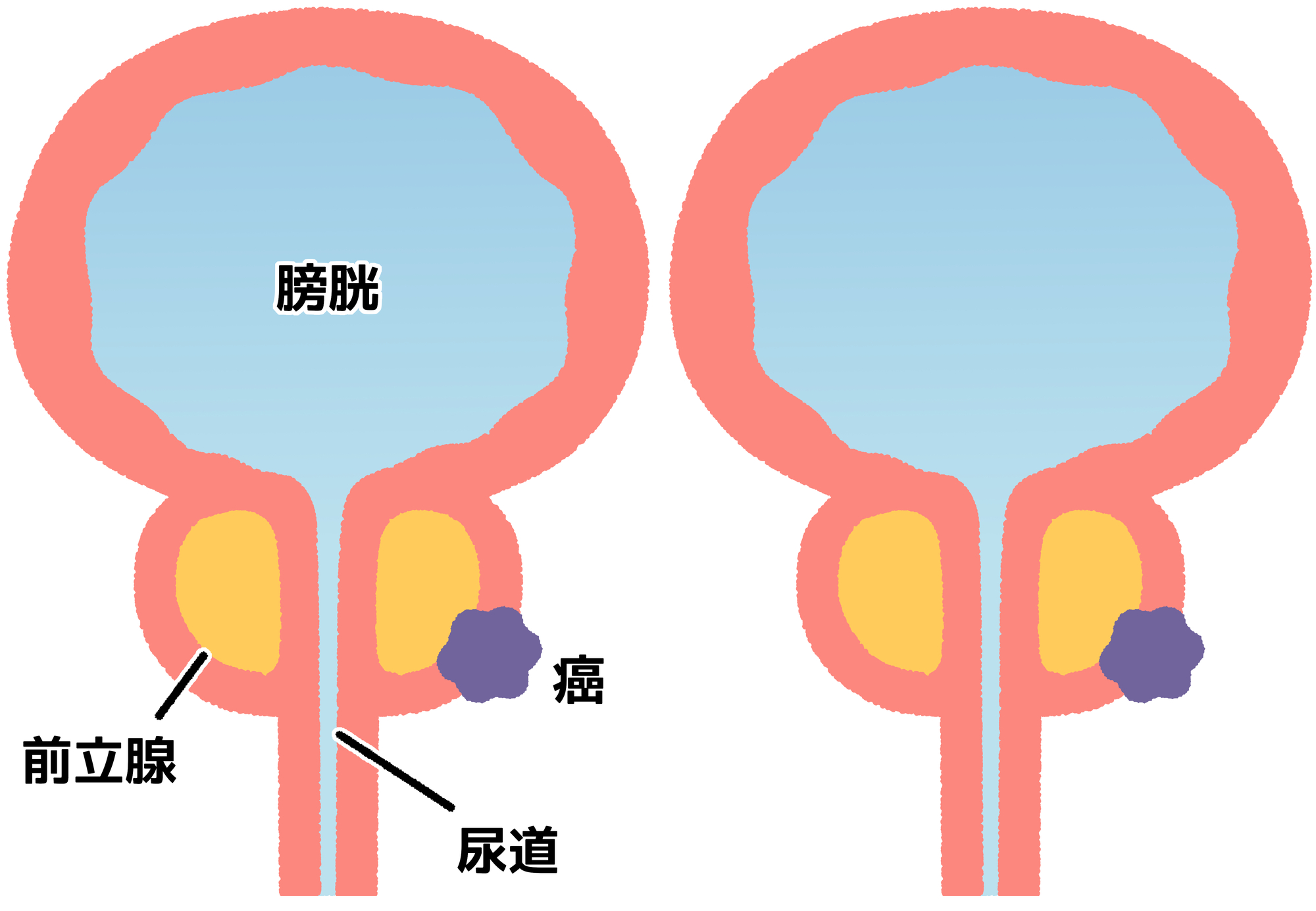 排尿トラブルだけじゃない！前立腺がんの症状と予防法について解説